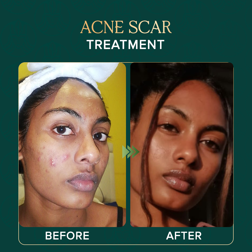 acne-scar