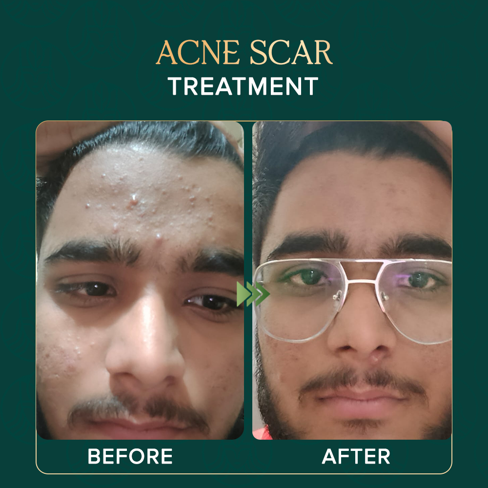 acne-scar