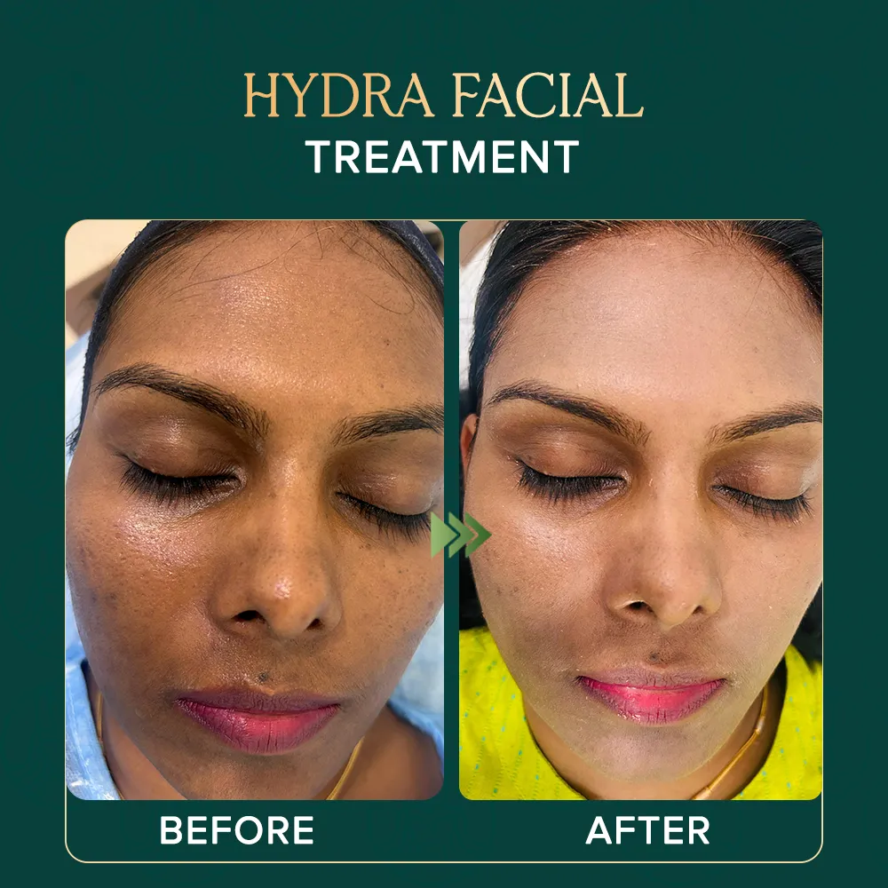 hydrafacial-treaatment