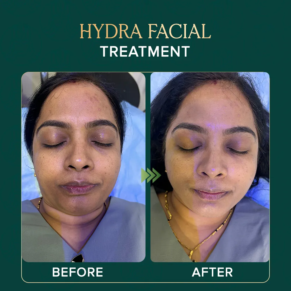 hydrafacial-treaatment