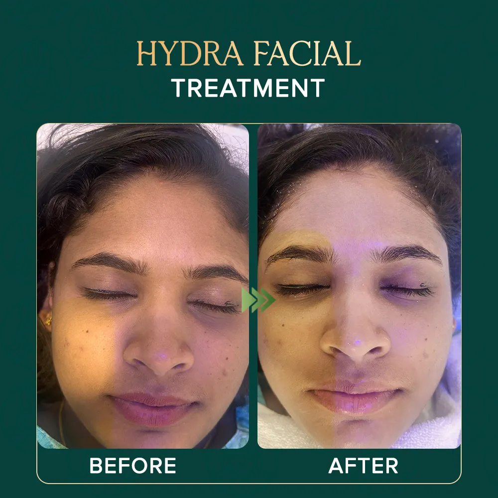 hydrafacial-treaatment