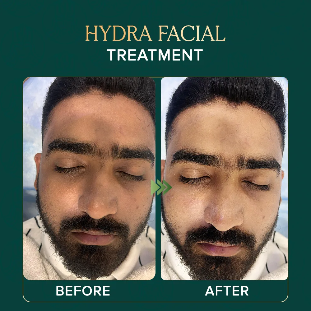 hydrafacial-treaatment