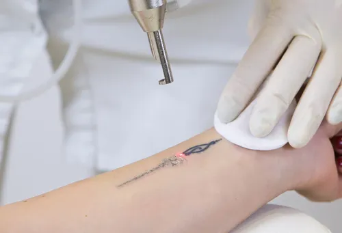 laser-tattoo-removal